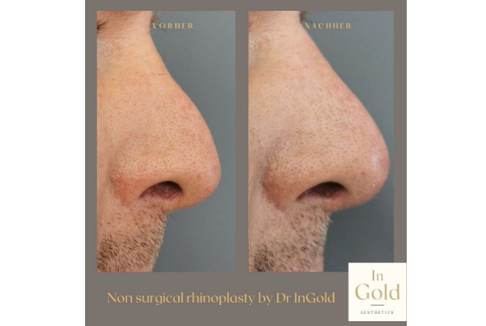 Non-surgical-rhinoplasty-030322.png