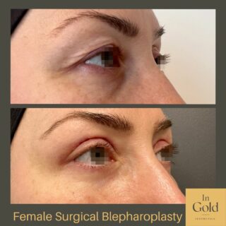 female surgical blepharoplasty 1