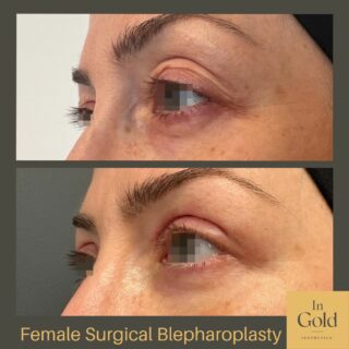 female surgical blepharoplasty 2