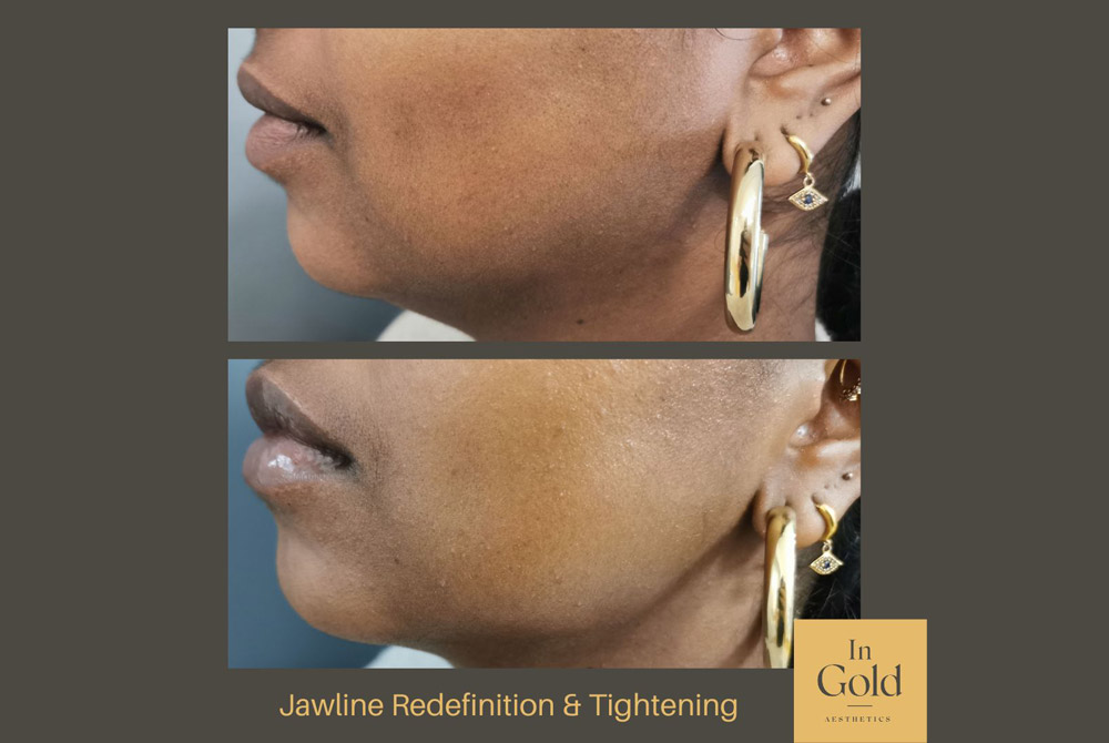 Jawline-Redefinition-Tightening-by-Dr.-Ingold-INTRO-PIC.jpg