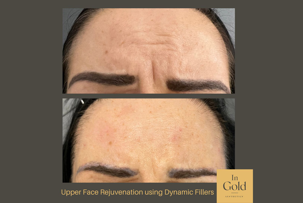 Upper-Face-Rejuvenation-using-Dynamic-Fillers-by-Dr.-Ingold-INTRO.jpg