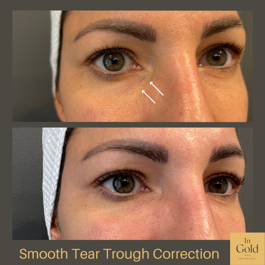 Smooth Tear Trough Correction by Dr. Ingold 1