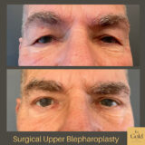 Surgical Upper Blepharoplasty by Dr. Ingold INTRO PIC