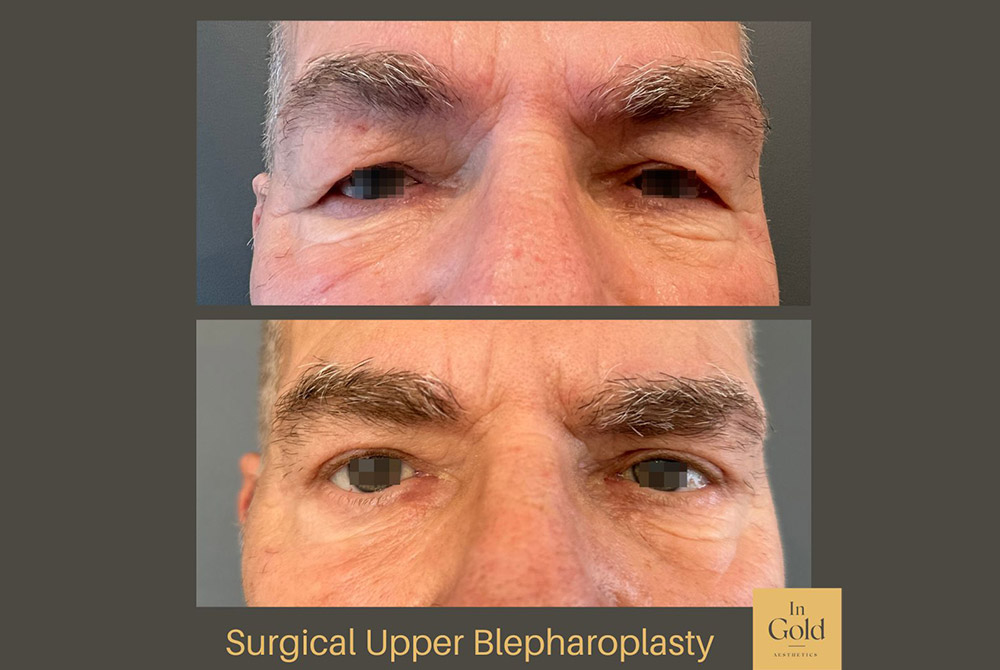 Surgical-Upper-Blepharoplasty-by-Dr.-Ingold-INTRO.jpg