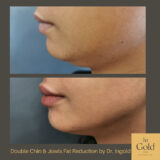 Double chin e jowls fat reduction by Dr. Ingold
