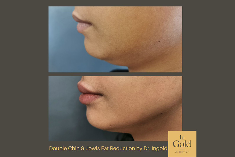 Double-chin-e-jowls-fat-reduction-by-Dr.-Ingold-INTRO.jpg