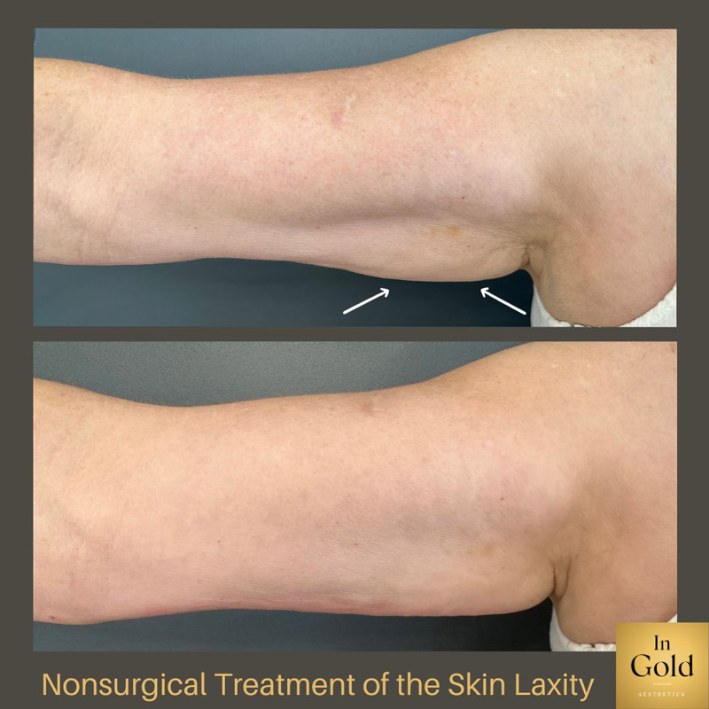 Nonsurgical-treatment-of-the-skin-laxity-by-Dr.-Ingold--inside-pic