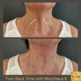 Turn back time with Morpheus 8 by Dr. Ingold INTRO