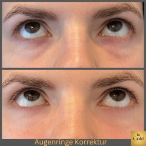 Augenringe-Korrektur 2