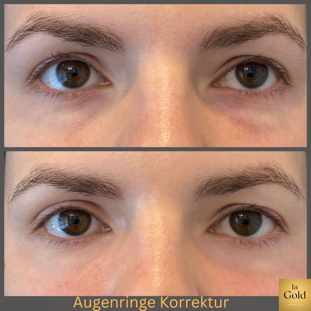 Augenringe-Korrektur1