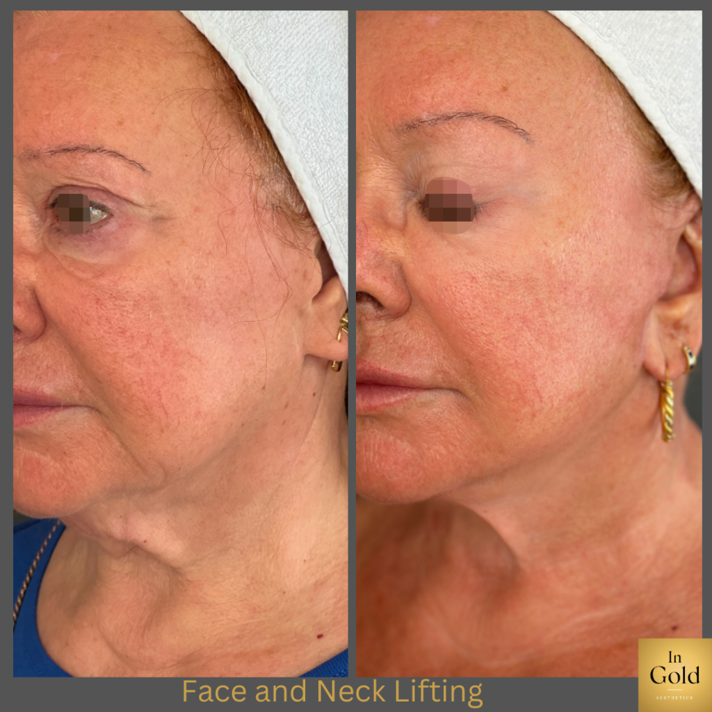 Face And Neck Lifting3