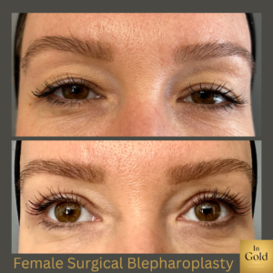 Female Surgical Blepharoplasty 1