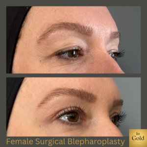 Female Surgical Blepharoplasty 2