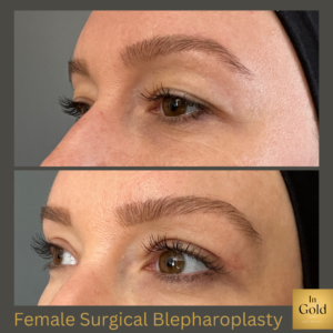 Female Surgical Blepharoplasty 3