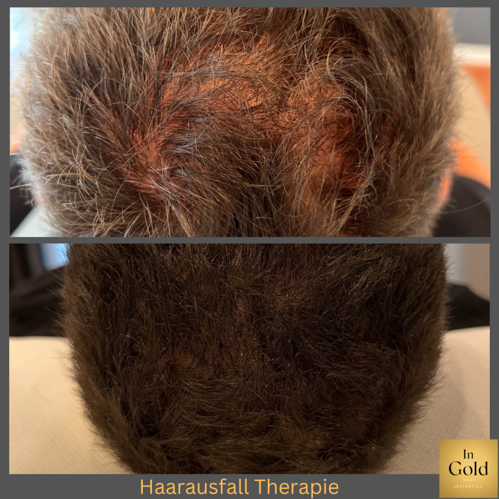 Haarausfall Therapie