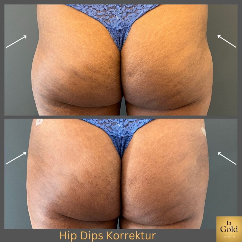 Hip Dips K.sh