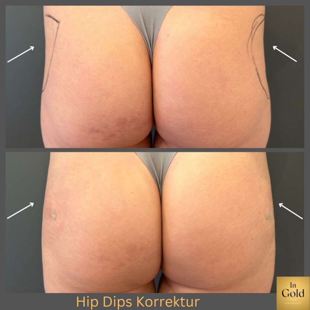 Hip Dips Vorher:nachher