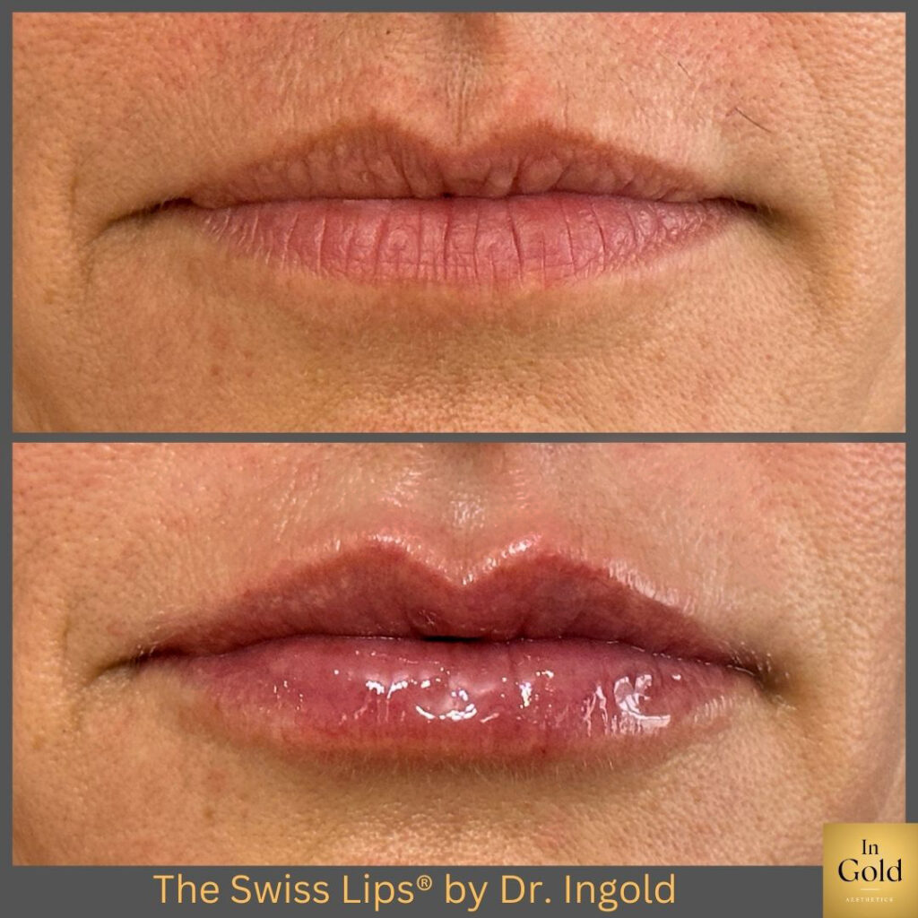 The Swiss Lips®️ By Dr. Ingold 1