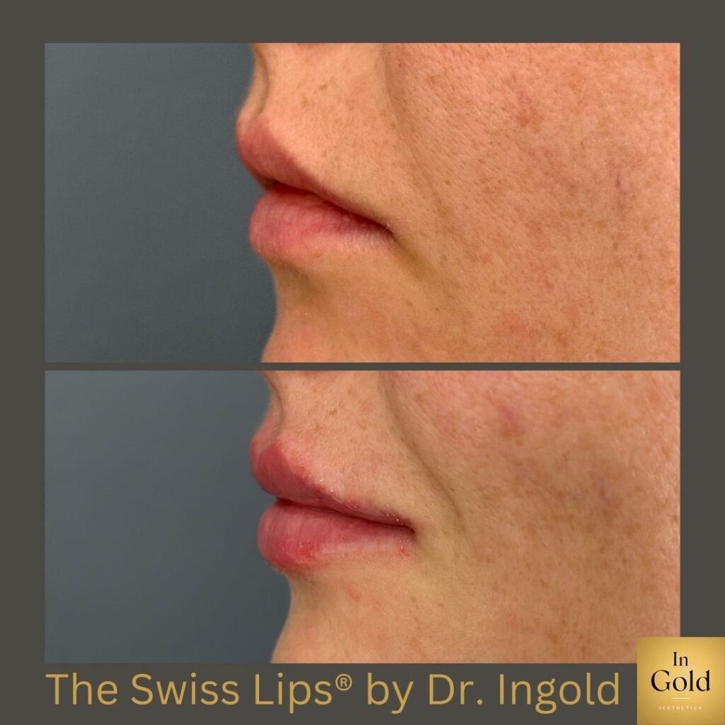 The Swiss Lips® By Dr. Ingold