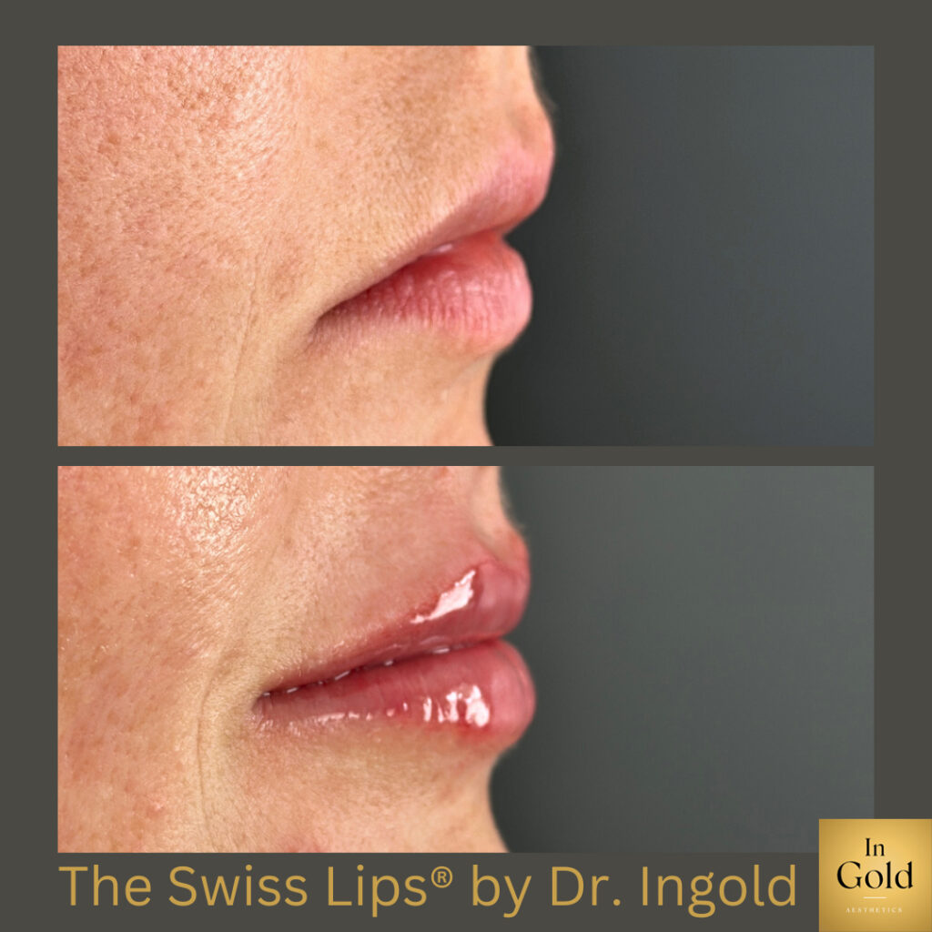 The Swiss Lips® By Dr. Ingold 1