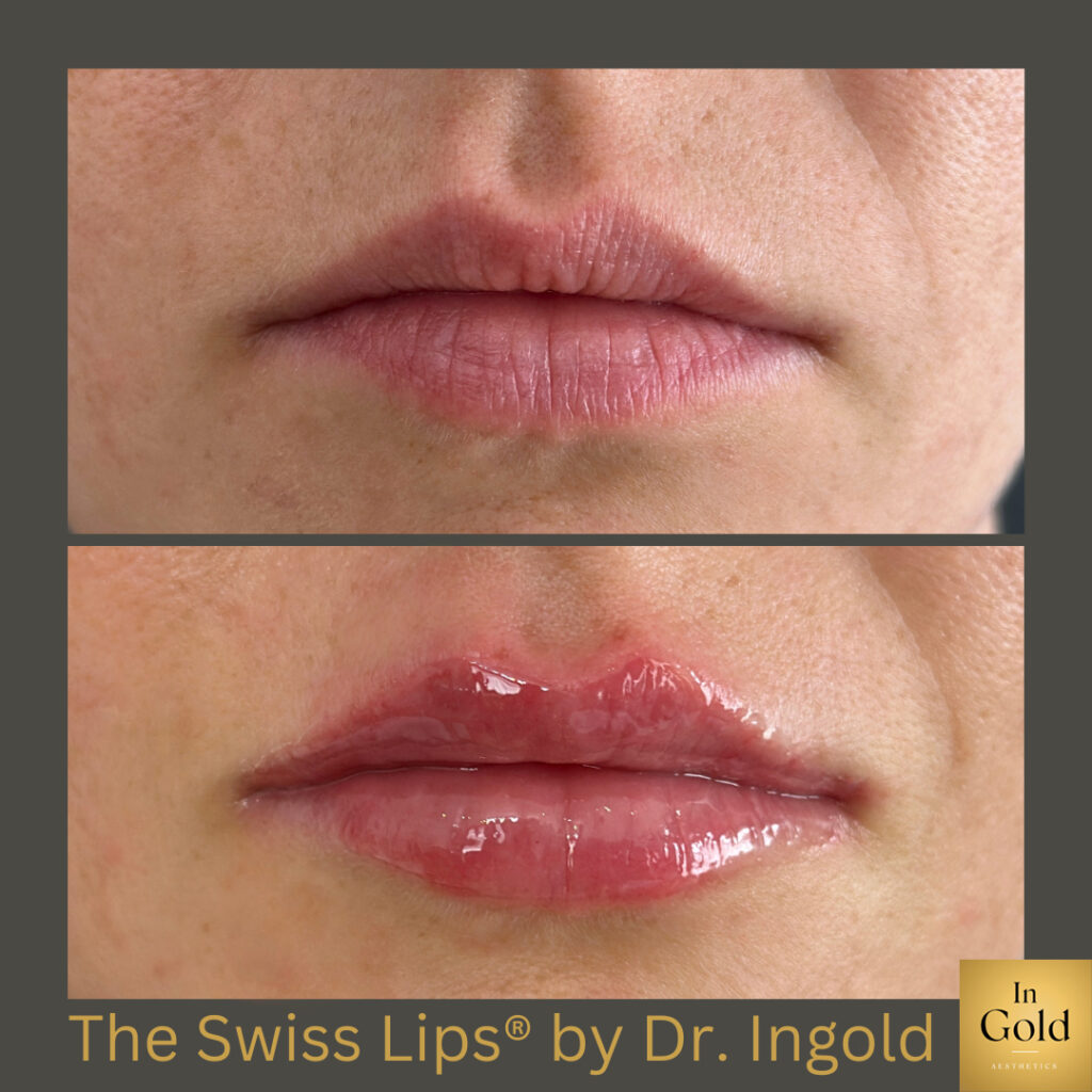 The Swiss Lips® By Dr. Ingold 1