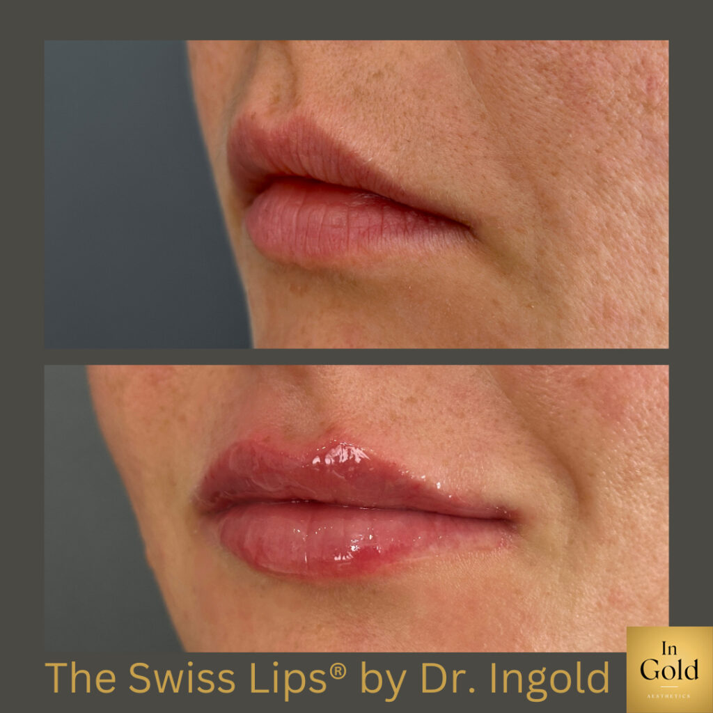 The Swiss Lips® By Dr. Ingold 1