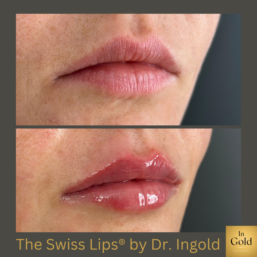 The Swiss Lips® By Dr. Ingold 1