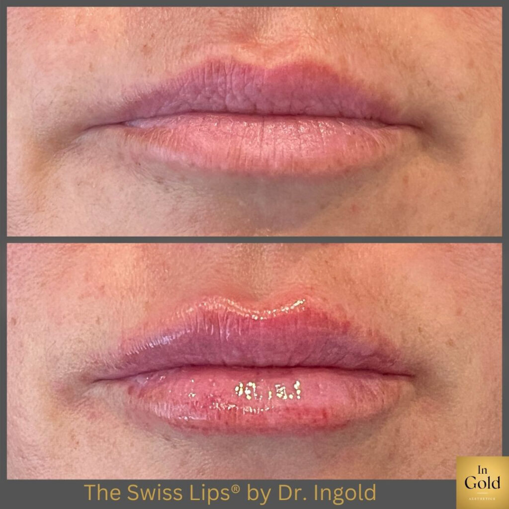 The Swiss Lips®️ By Dr. Ingold 1