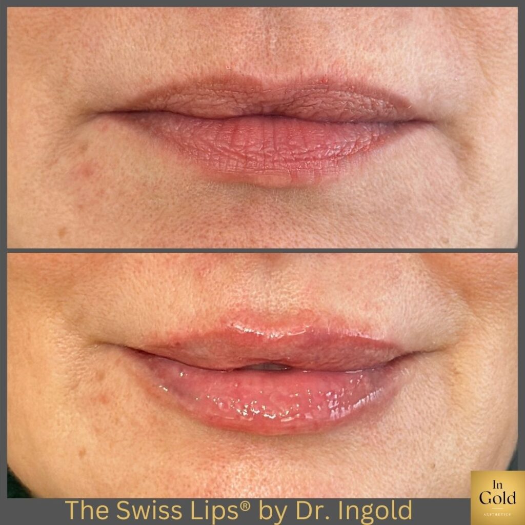 The Swiss Lips®️ By Dr. Ingold Z.w