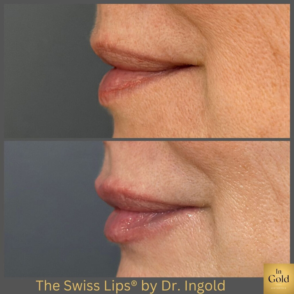 The Swiss Lips®️ By Dr. Ingold 1