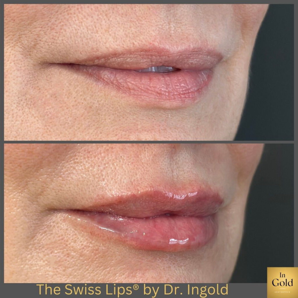 The Swiss Lips®️ By Dr. Ingold 1