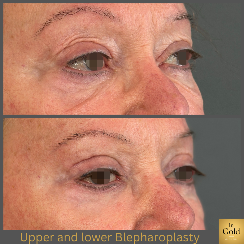 Upper And Lower Blepharoplasty3