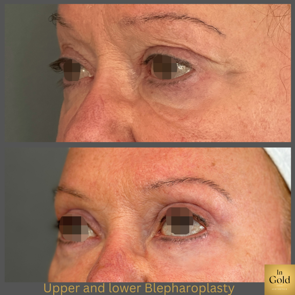 Upper And Lower Blepharoplasty4