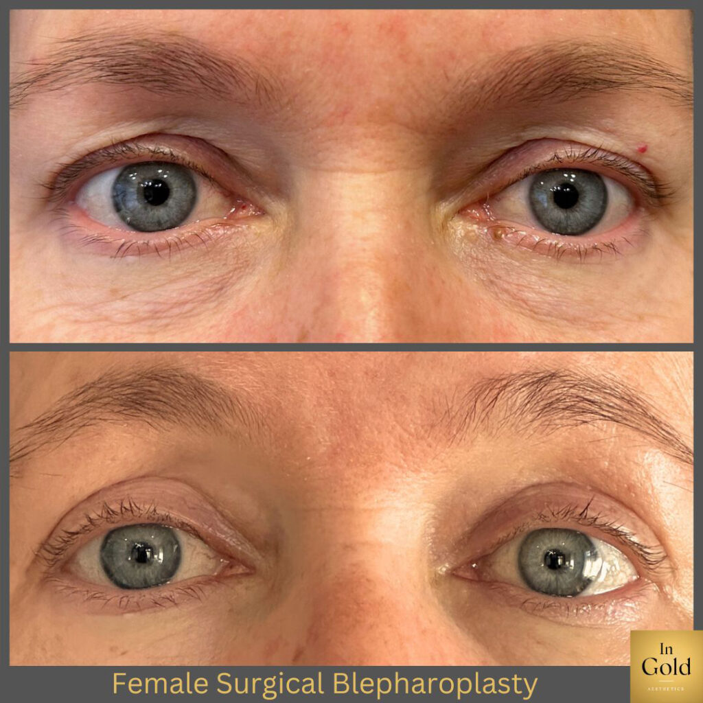 Female Surgical Blepharoplasty 1