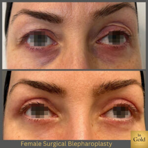 Female Surgical Blepharoplasty 1