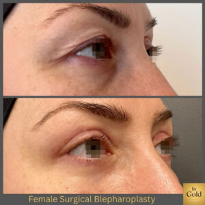 Female Surgical Blepharoplasty 1