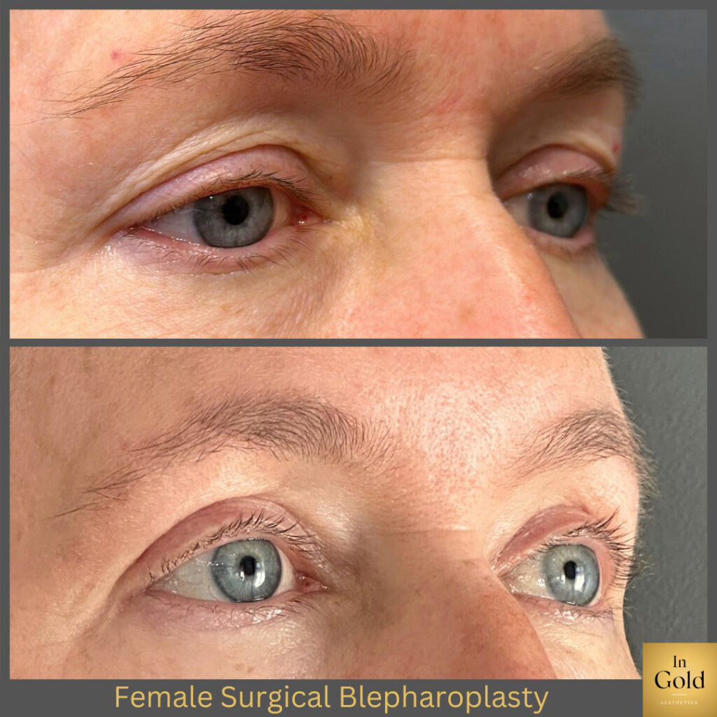 Female Surgical Blepharoplasty 1