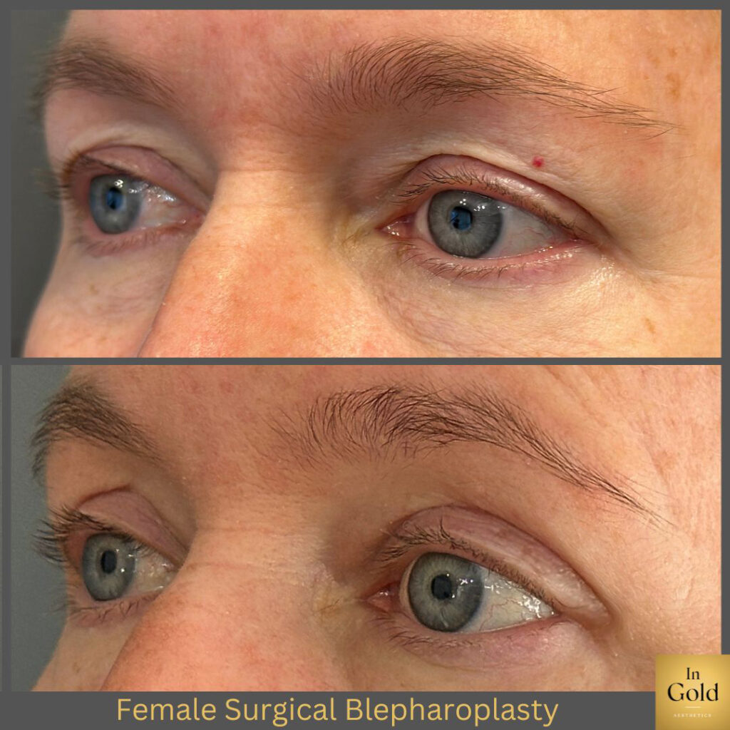 Female Surgical Blepharoplasty 1