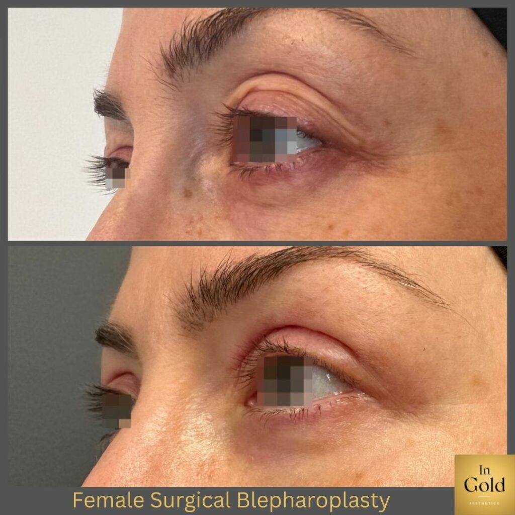 Female Surgical Blepharoplasty 4