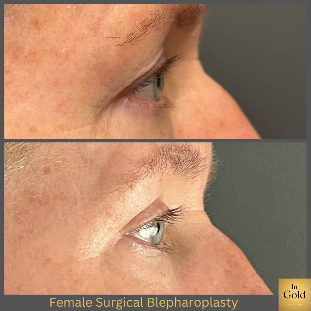 Female Surgical Blepharoplasty 1