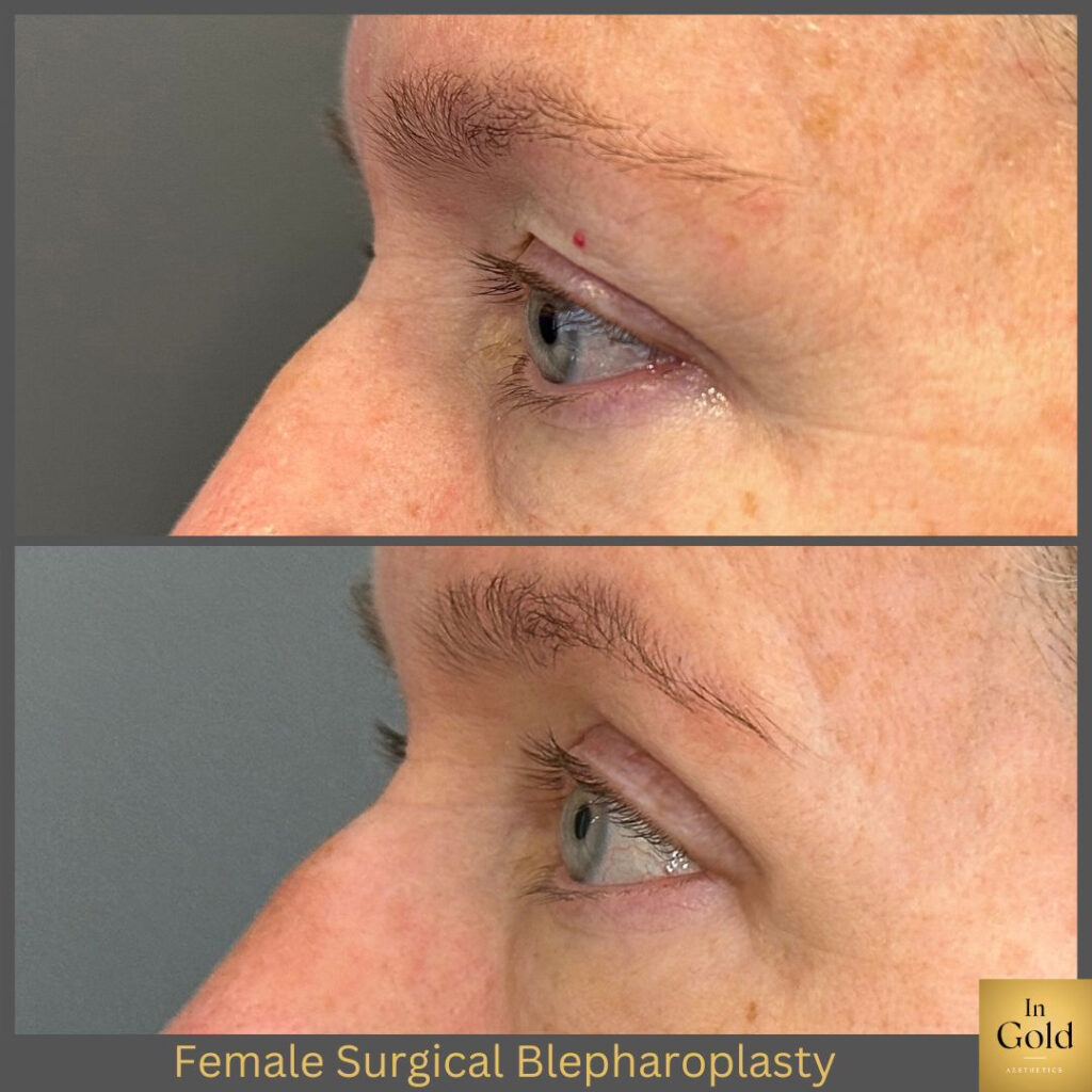 Female Surgical Blepharoplasty 1