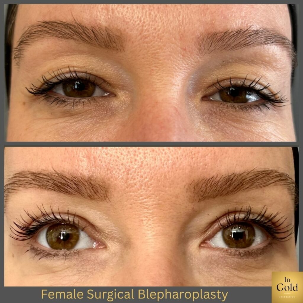 Female Surgical Blepharoplasty