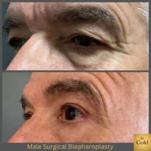 Female Surgical Blepharoplasty 1