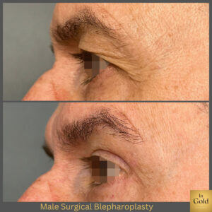 Male Surgical Blepharoplasty 1