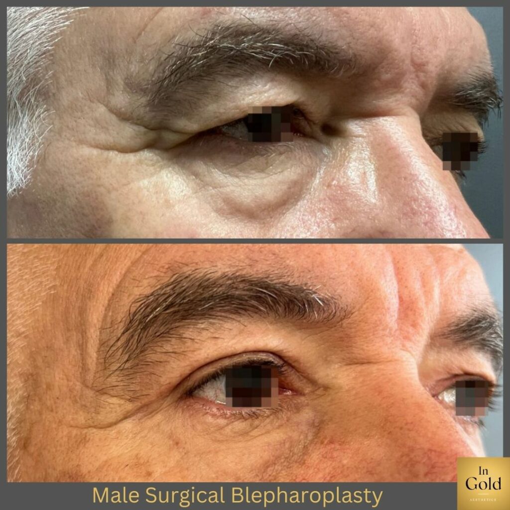 Male Surgical Blepharoplasty 3