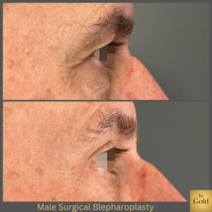 Male Surgical Blepharoplasty 1