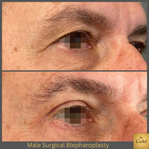 Male Surgical Blepharoplasty 1