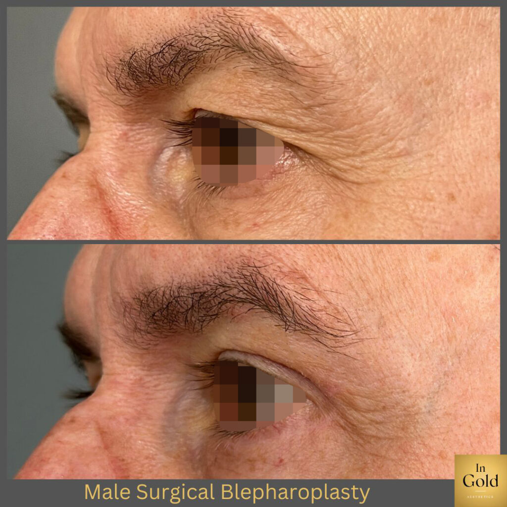 Male Surgical Blepharoplasty 1