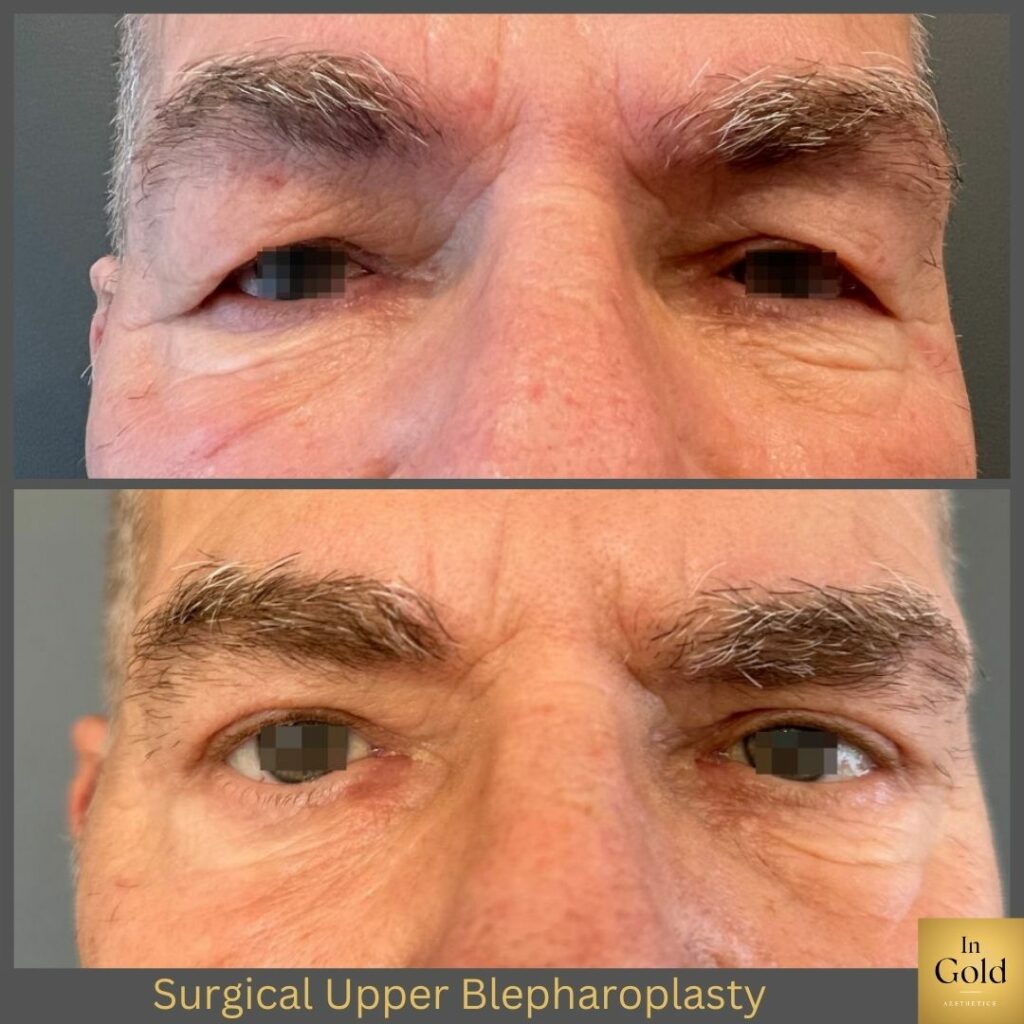 Surgical Upper Blepharoplasty