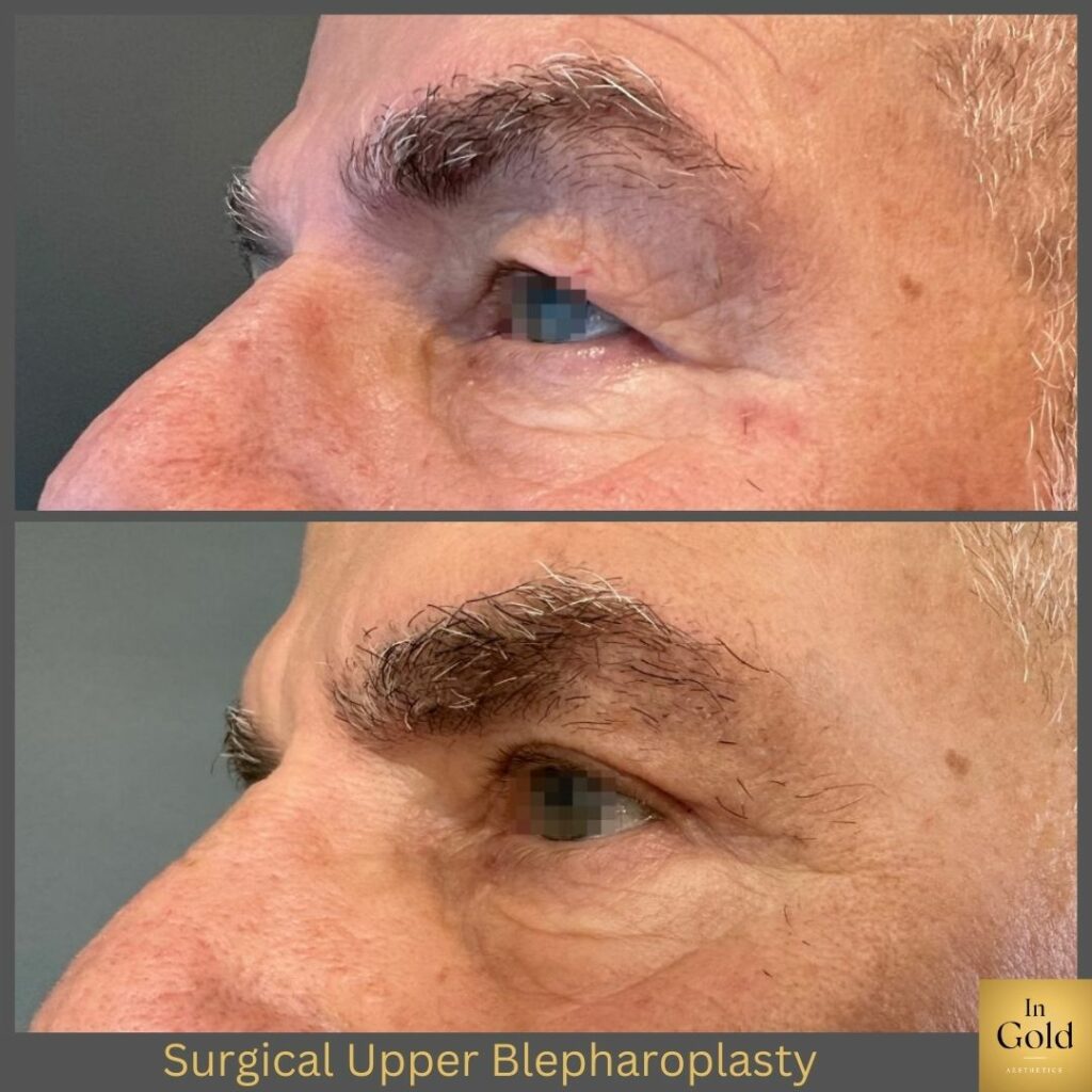 Surgical Upper Blepharoplasty02